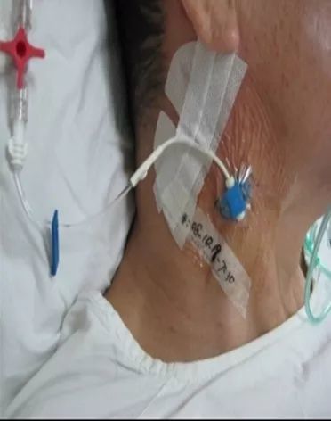 CVC怎样护理？所有重点都在这里了！_腾讯新闻