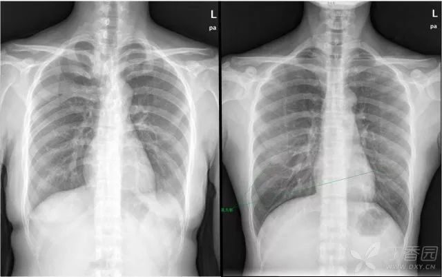 如何读好一张胸片?你和主任就差这 4 点
