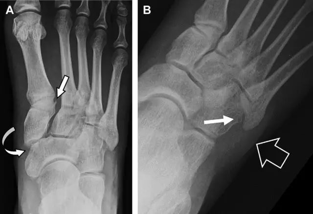 骨折在靠近内侧楔骨处(箭头);b 外侧跗跖关节损伤伴随从骰骨跖骨韧