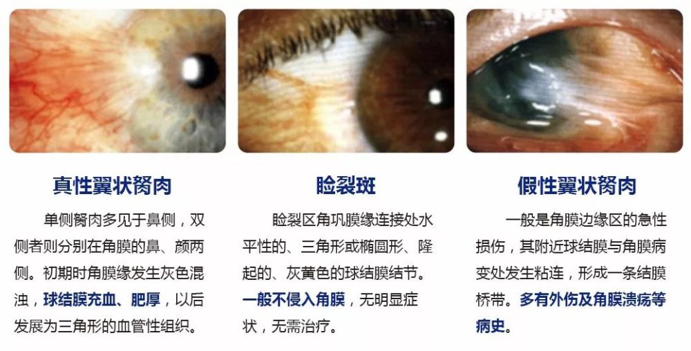 翼狀胬肉就其形態而言可以分為3個部分:長在黑眼珠上,是胬肉的尖端