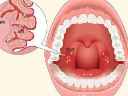 知名歌手患扁桃体癌 什么是扁桃体癌 让医生告诉你答案 腾讯新闻
