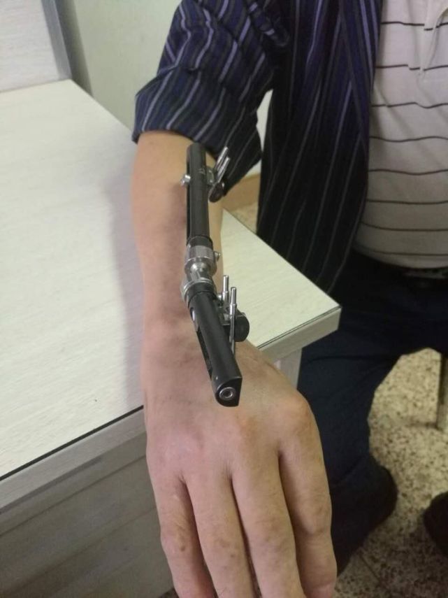 被虾刺了一下男子手臂烂得差点截肢 这种病菌太可怕