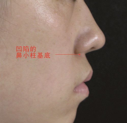 ▼严重的鼻小柱基底凹陷,则会和鼻综合整形同时进行,术中把假体雕刻成