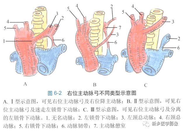 胸腹主动脉先天变异CT分析