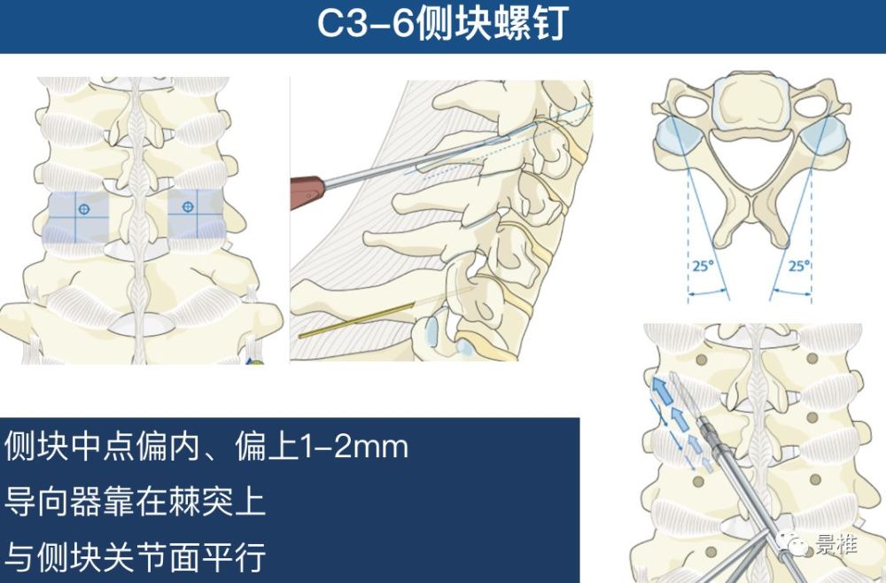 骨科精读颈椎胸椎腰椎椎弓根置钉技巧真的太实用了