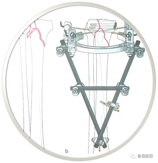 脛骨平臺骨折的幾種螺釘固定技術