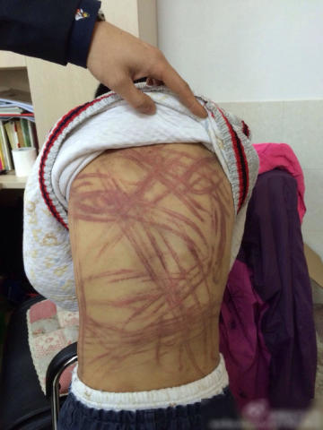 网曝南京9岁男童遭养父母虐待伤痕累累