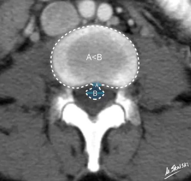 腰椎间盘突出|干货：椎间盘突出的程度及具体辨析