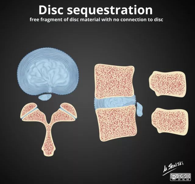 腰椎间盘突出|干货：椎间盘突出的程度及具体辨析