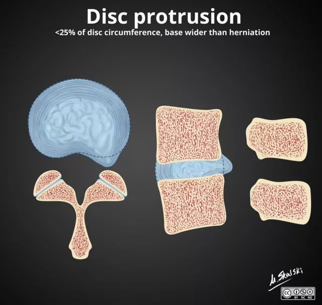 腰椎间盘突出|干货：椎间盘突出的程度及具体辨析