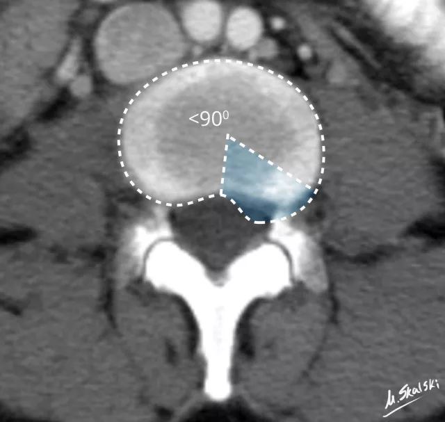 腰椎间盘突出|干货：椎间盘突出的程度及具体辨析