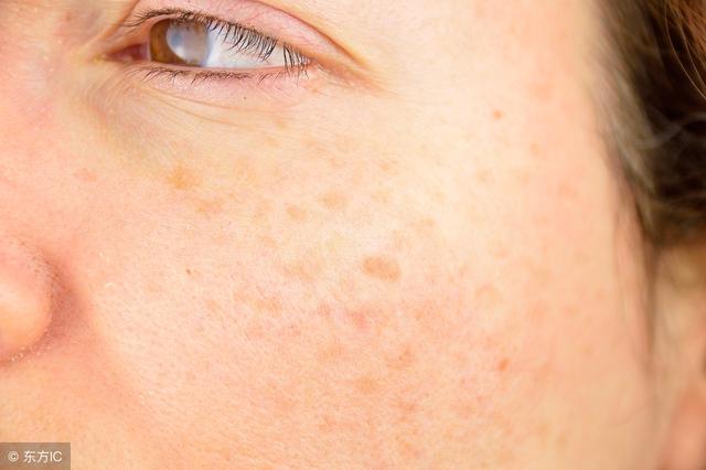 生完宝宝后长雀斑 不用天价化妆品 用干净的茄子皮敷脸