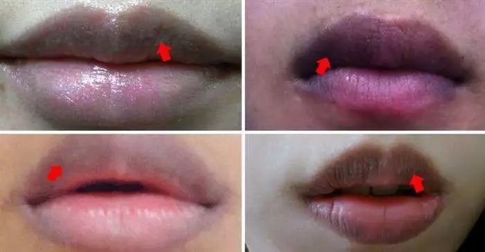 女人嘴唇发紫是什么病图片