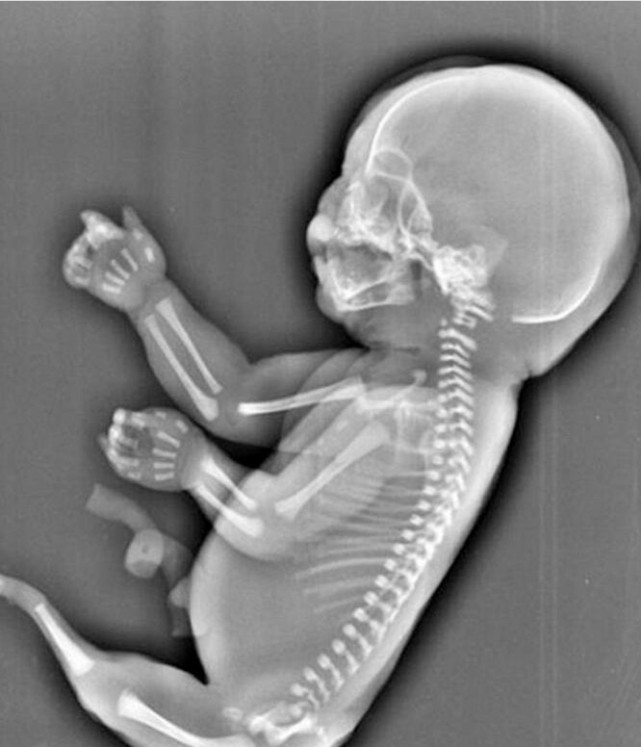 患有人鱼综合征的孩子仍阳光成长,一次小感冒却将她带走