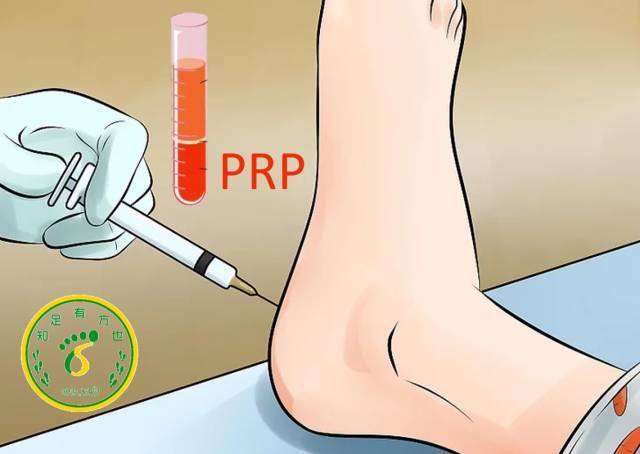 prp(富血小板血浆)注射prp是将自己的静脉血通过离心的方法提取出来的