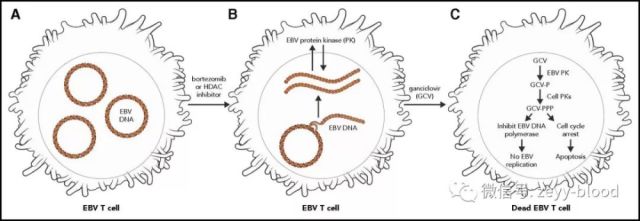 如何治疗T细胞慢性活动性EB病毒感染
