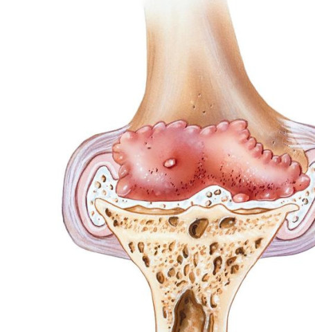 滑膜炎并不难治,导致滑膜炎的原因有哪些