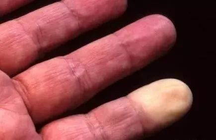 黄帝内经你的身体有没有血栓量量两条小腿就知道