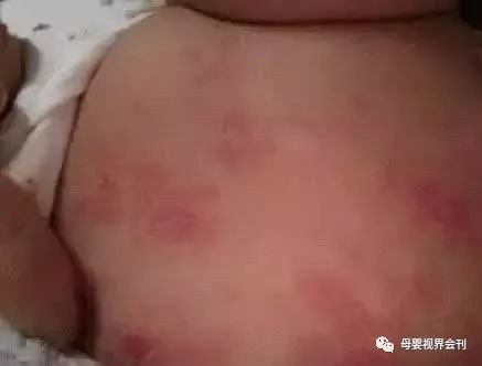 这些并不是婴儿湿疹 别再傻傻分不清 荨麻疹 颈部 婴儿湿疹 痤疮 湿疹 风疹 皮肤瘙痒 幼儿急疹 皮疹 痱子