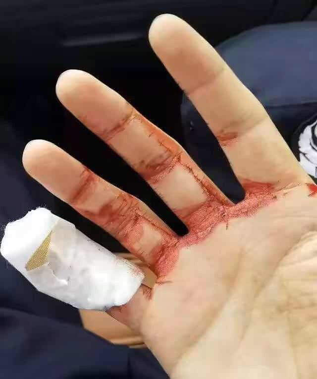 在救助过程中,良渚派出所辅警王立才右手手指被玻璃划伤.