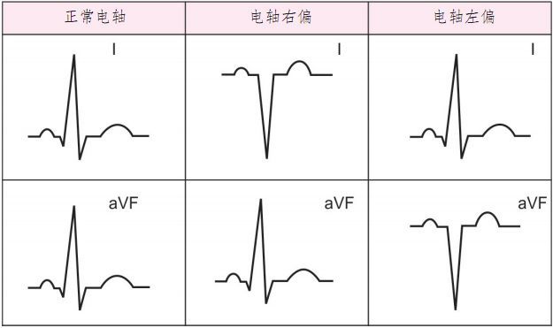 心电轴正常时,两导联的qrs波均向上.电轴04病理性:心房颤动,心室颤动.