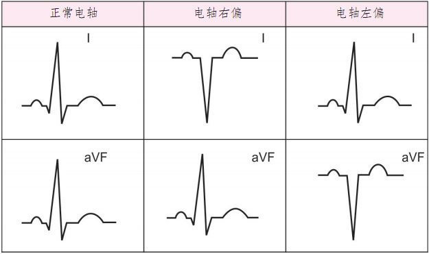心电轴正常时,两导联的qrs波均向上电轴04病理性:心房颤动,心室颤动