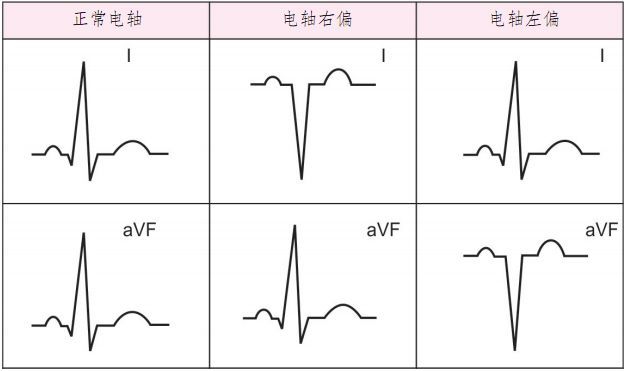 心电轴右偏心电图表现图片