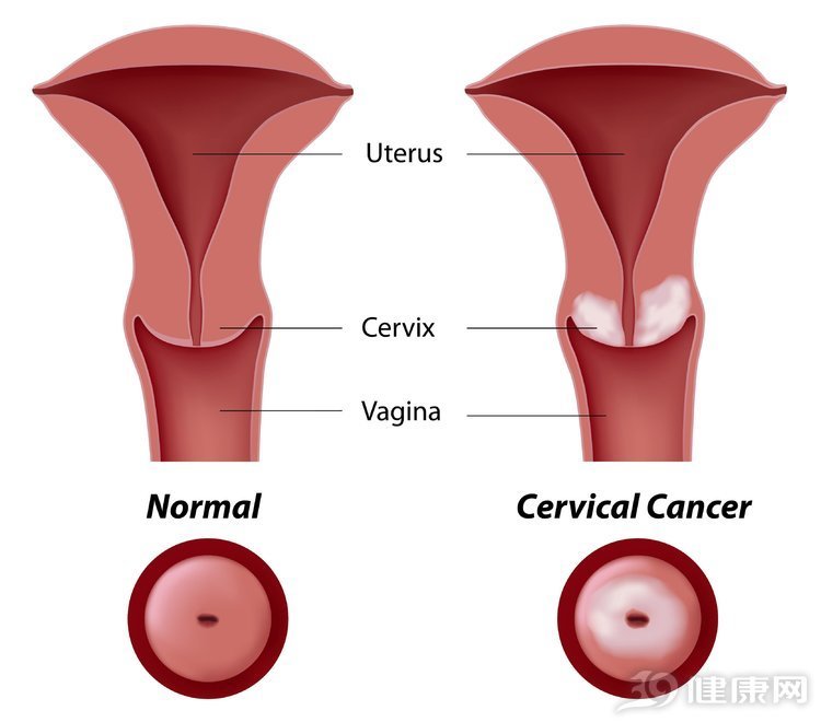 做好準備:這幾種女人,將來很可能得宮頸癌!