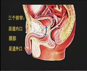 剖腹产插尿管图解图片