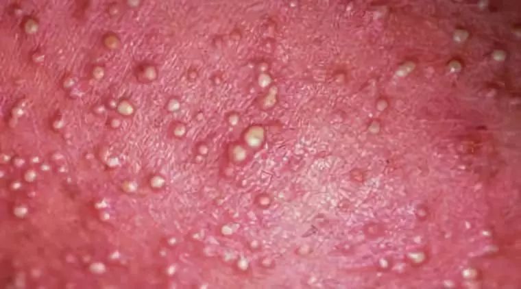 湿疹和痱子分不清?儿科医生教你 4 招轻松区分和护理