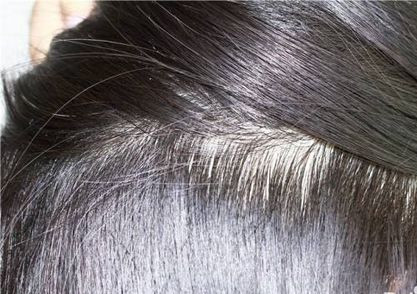 头皮毛囊炎容易脱发,5个调理方法,给房子消毒