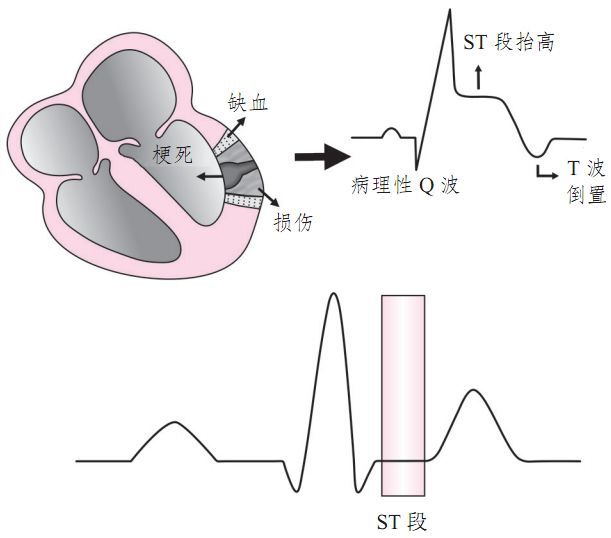 病理性q波振幅≥1/3qrs波且q波時限≥0.03s提示心肌梗死或心肌壞死.