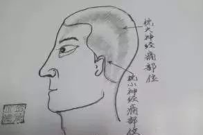 后脑勺的机关——头痛头晕治疗点