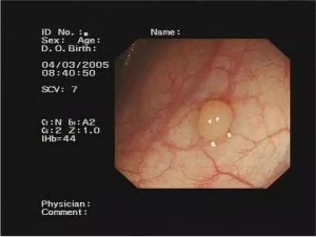 大肠息肉切除后有哪些注意事项?