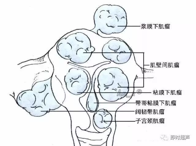 子宮肌瘤超聲分類診斷