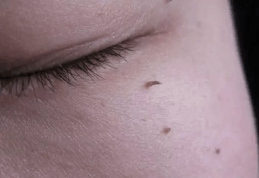 皮肤出现不明原因的小肉疙瘩?当心是这些问题