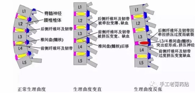 腰椎曲度变直!腰椎间盘突出,治疗效果不好,容易