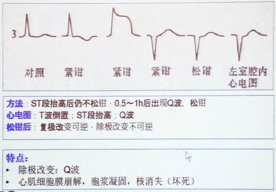 冠心病心肌缺血如何用心電圖進行定位診斷