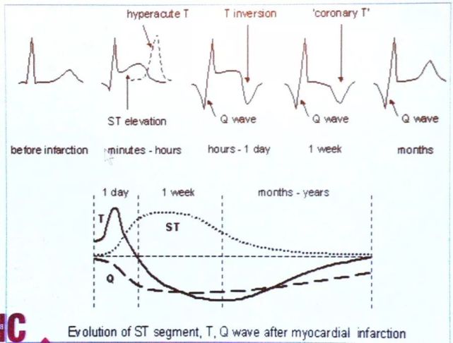 病理性q波可长期存在或发生改变或全部消失(数月至数年); st段多为