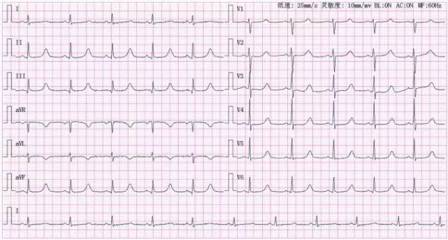 如何讀懂心電圖危急值?快看!