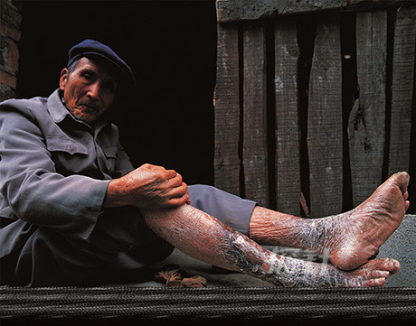 细菌战系列报道罕见的怪病