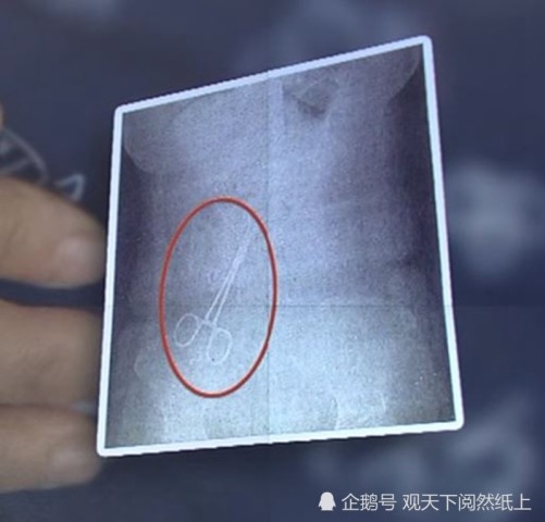 女子机场安检时遭拒绝 肚子里遗留的异物成罪