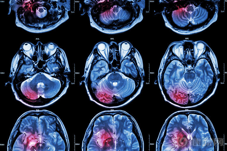 脑梗|过了50岁不想脑梗，医生提醒：厨房内3种调料，能少加就少加！