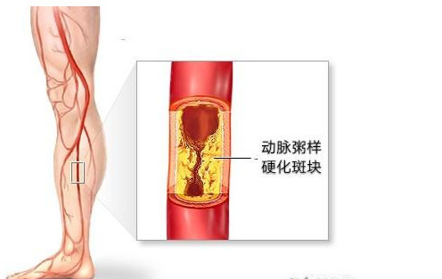 下肢动脉硬化是如何引起的 该怎样预防呢