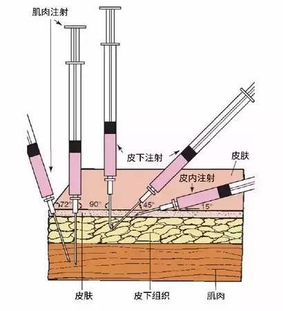 肌肉针的打法图片