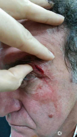 库卡眼皮被打裂 2cm血口清晰可见