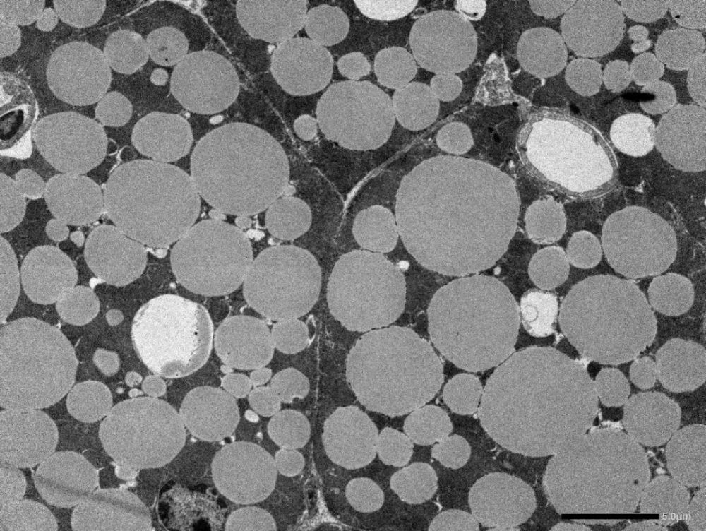 逐渐地,脂肪细胞内的脂滴越来越大,挤压其他细胞器,在显微镜下甚至