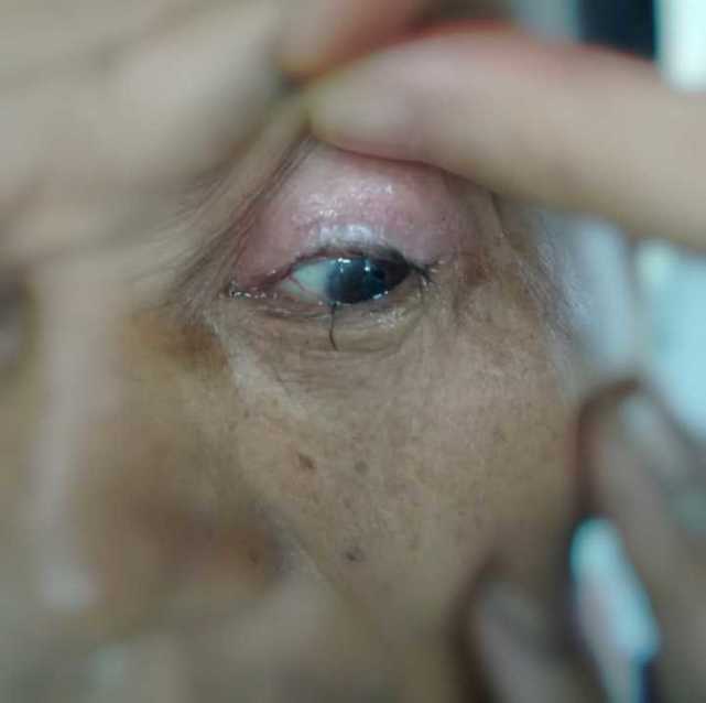 钢丝突然飞来 插入男子眼球1厘米深