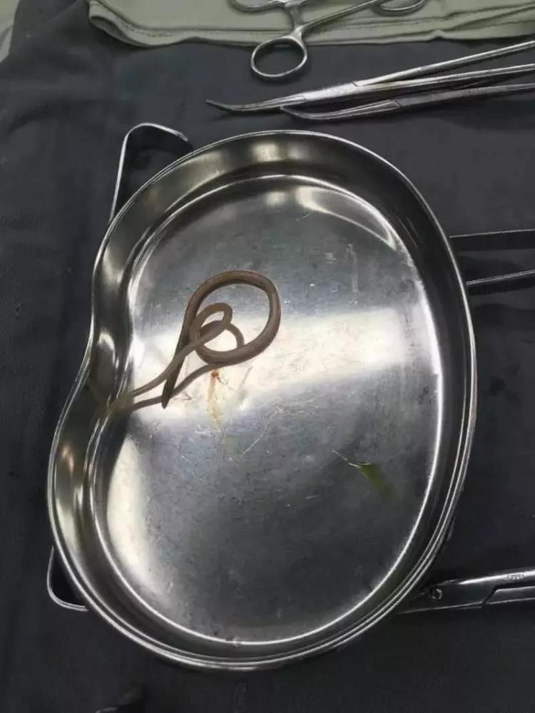 女子腹痛一周多 原来是肚子里的蛔虫在作怪