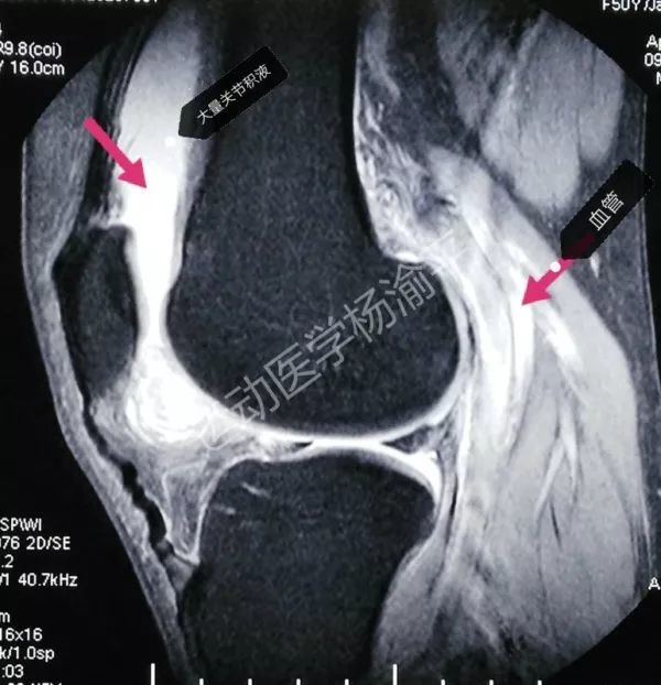 关节积液到底是不是病